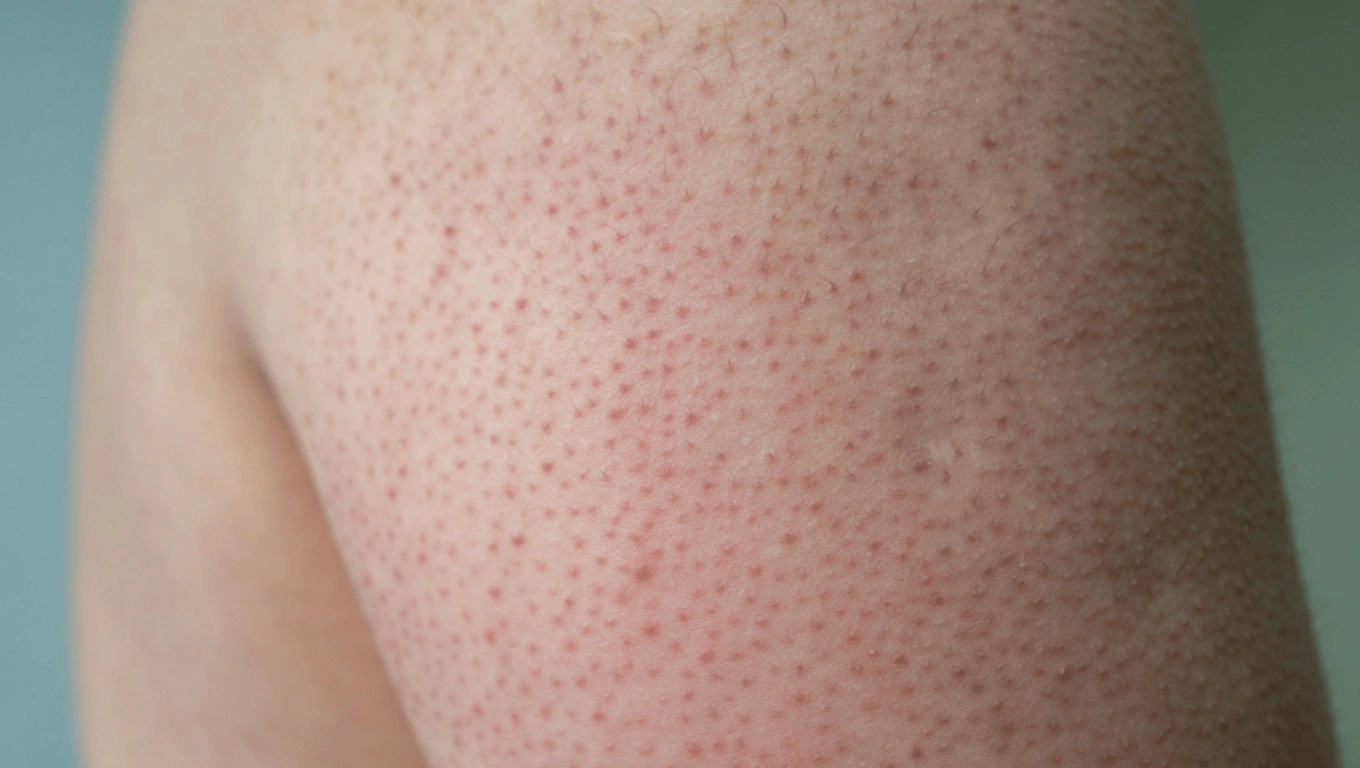 لکه های قرمز پوست مرغی 