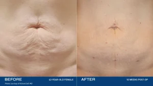 عکس قبل و بعد از درمان افتادگی پوست شکم با رنوویون