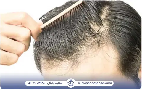 چرا موها دچار ریزش میشوند؟