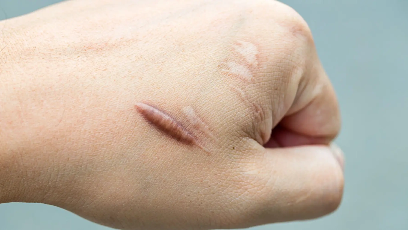  اسکار هایپرتروفیک