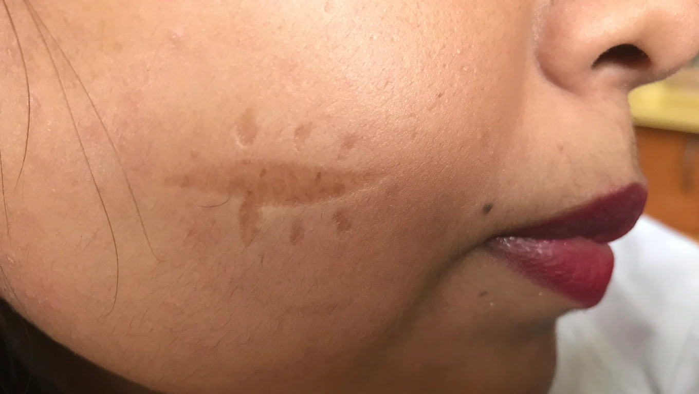  اسکار آتروفیک