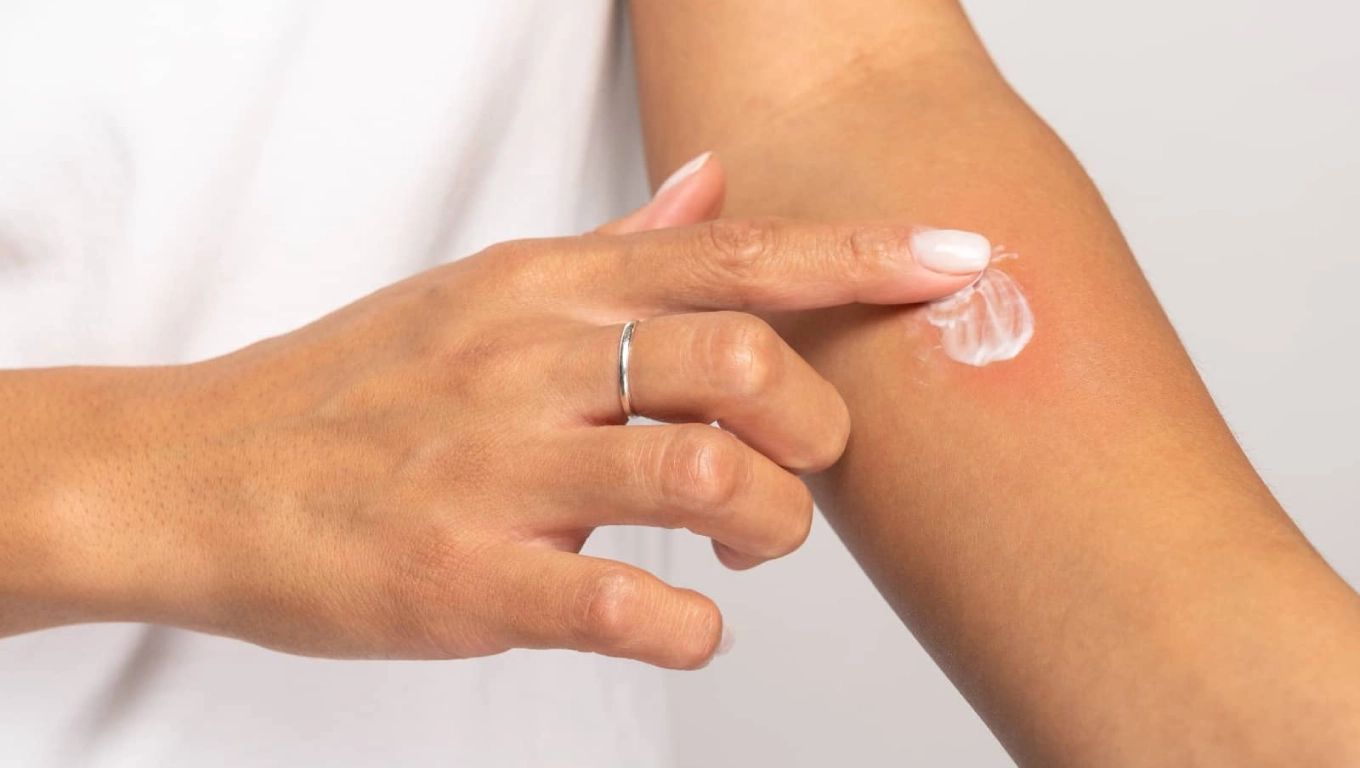 درمان قارچ پوستی