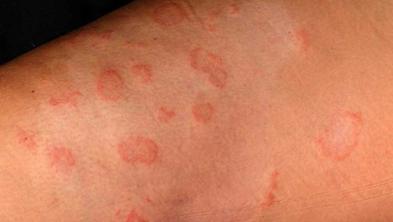 تصویر قارچ پوستی کرم حلقه ای