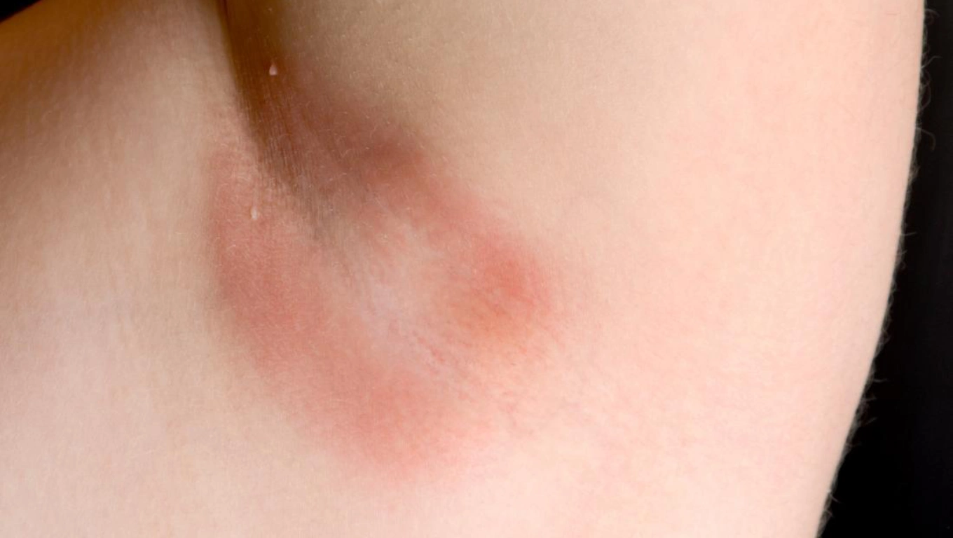 تصویر قارچ پوستی برفک (کاندیدیازیس)