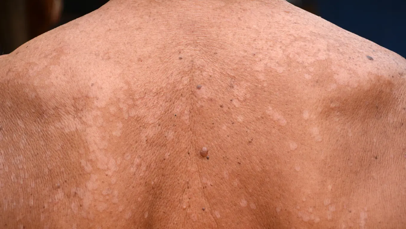 تصویر قارچ پوستی پیتریازیس ورسیکالر (Tinea Versicolor)