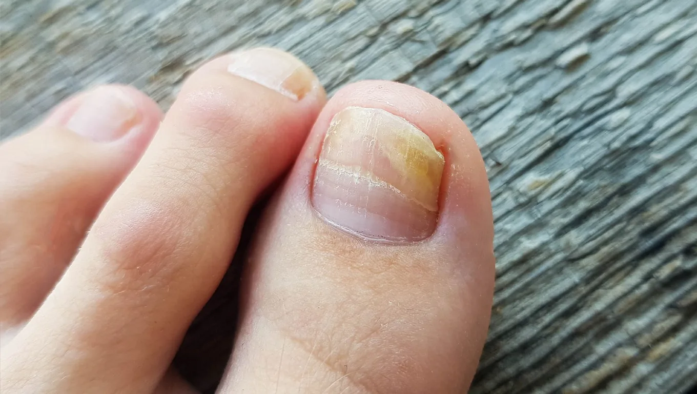 تصویر قارچ پوستی ناخن