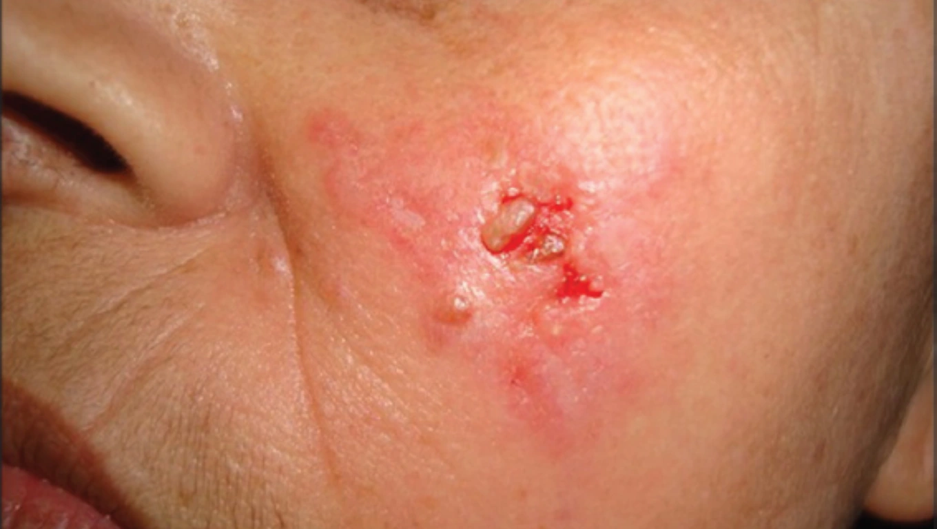 تصویر قارچ پوستی اسپوروتریکوز (Sporotrichosis)