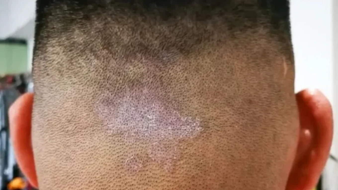 تصویر قارچ پوست سر