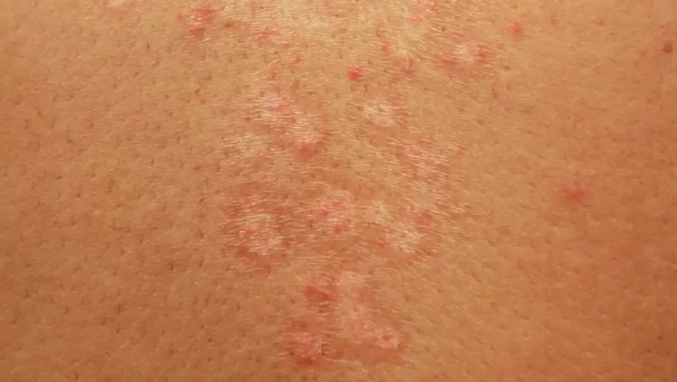 جلوگیری از قارچ ‌های پوستی