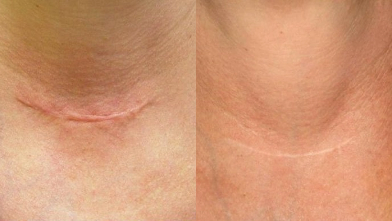 عکس قبل و بعد از ترمیم جای بخیه