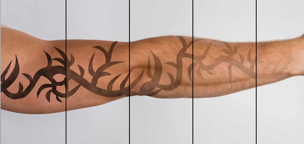 پاک کردن تتو به تدریج با لیزر