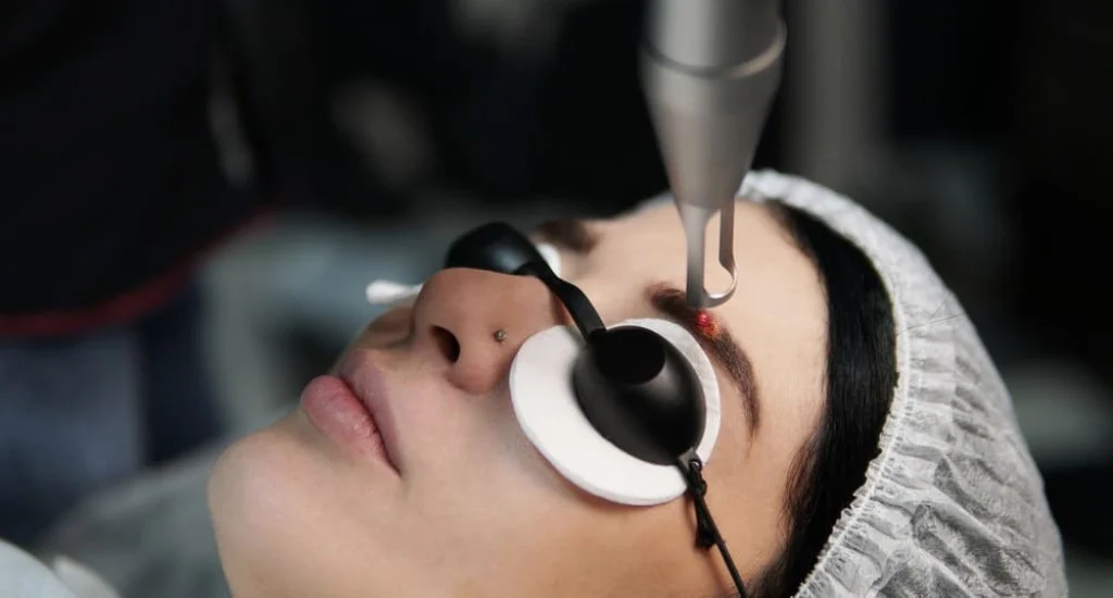 پاک کردن تتوی ابرو با لیزر 