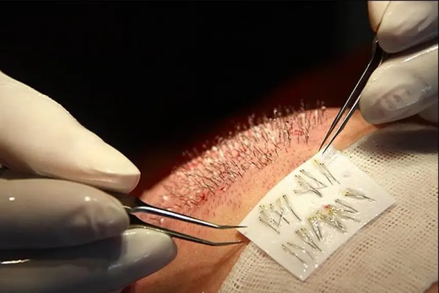 جنس و تراکم موها در ناحیه بانک مو