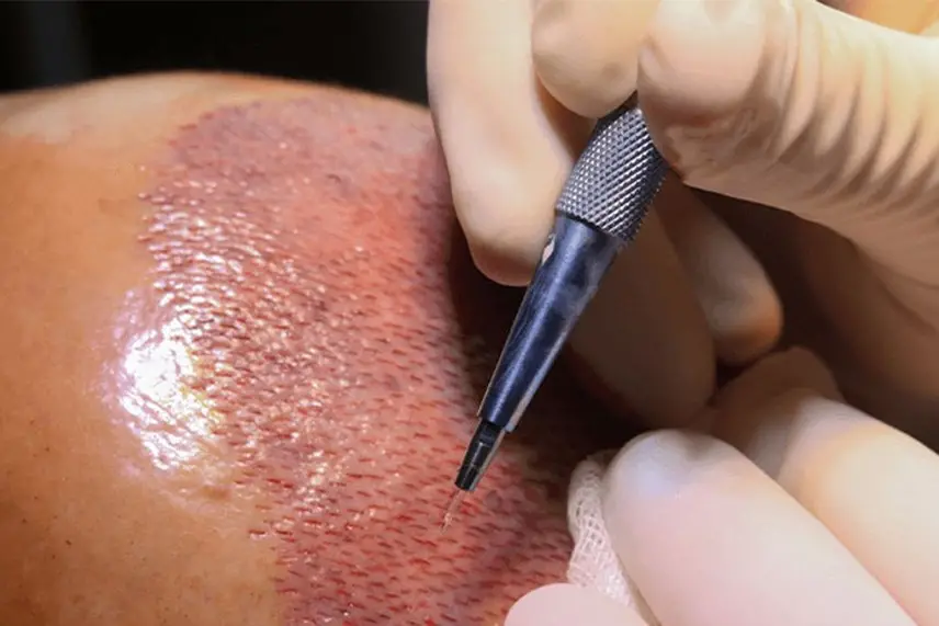 عوامل موثر بر زمان کاشت مو