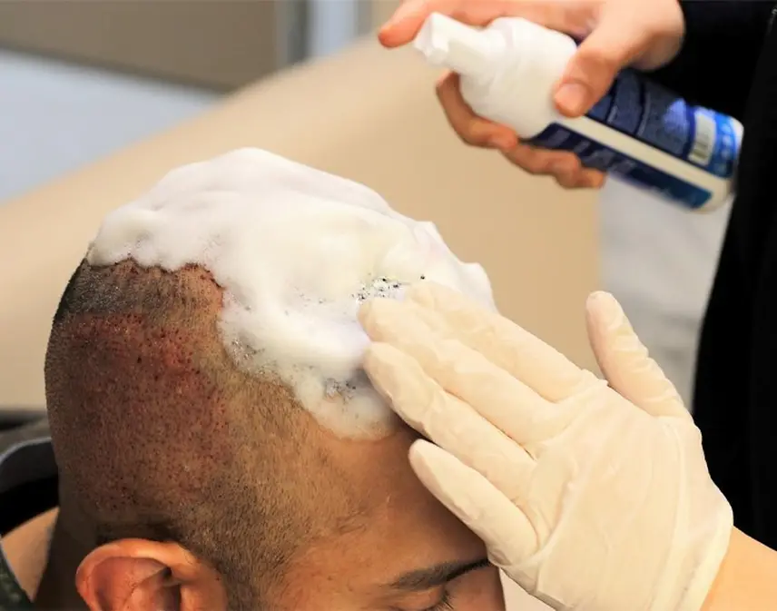 اولین شستشو بعد از کاشت مو