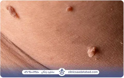 عمل جراحی برای درمان زگیل تناسلی در زنان و مردان