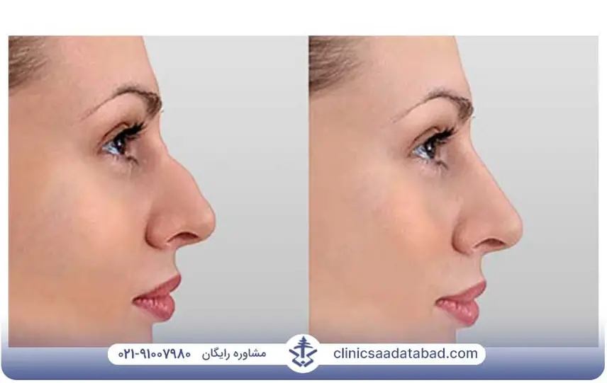 نتیجه لیفت بینی با نخ