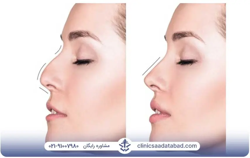 نمونه لیفت بینی با نخ