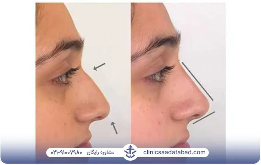 بعد از لیفت بینی با نخ