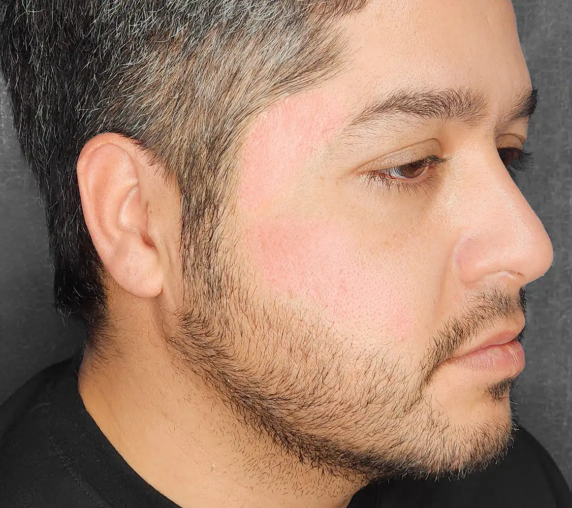 عکس بعد از لیزر اربیوم