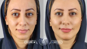 عکس تزریق چربی به صورت