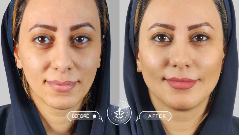 عکس تزریق چربی به صورت